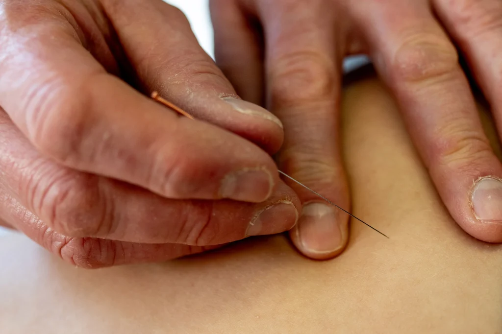 dry needling